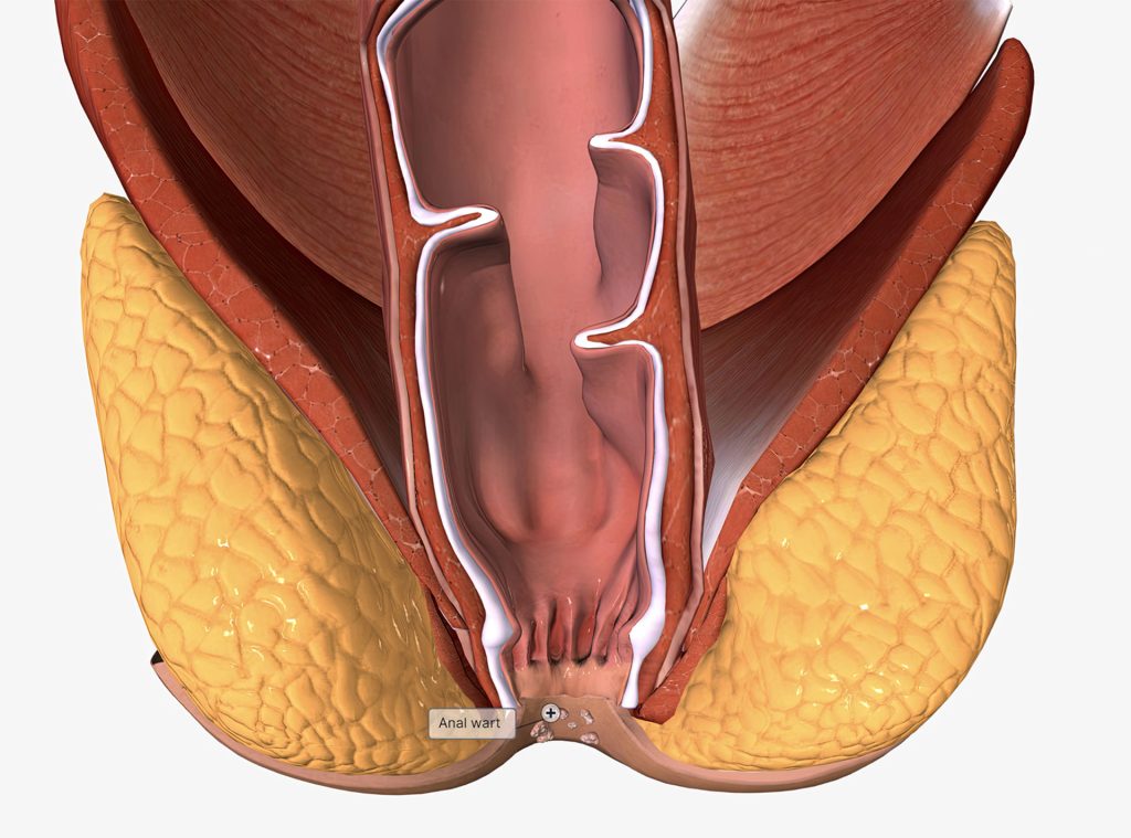 Anal Warts And Hpv Dr Neeraj Singh Md Facs Fascrs