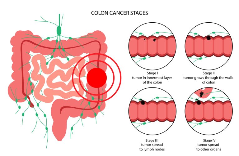 Colon Cancer - Dr Neeraj Singh Md Facs Fascrs