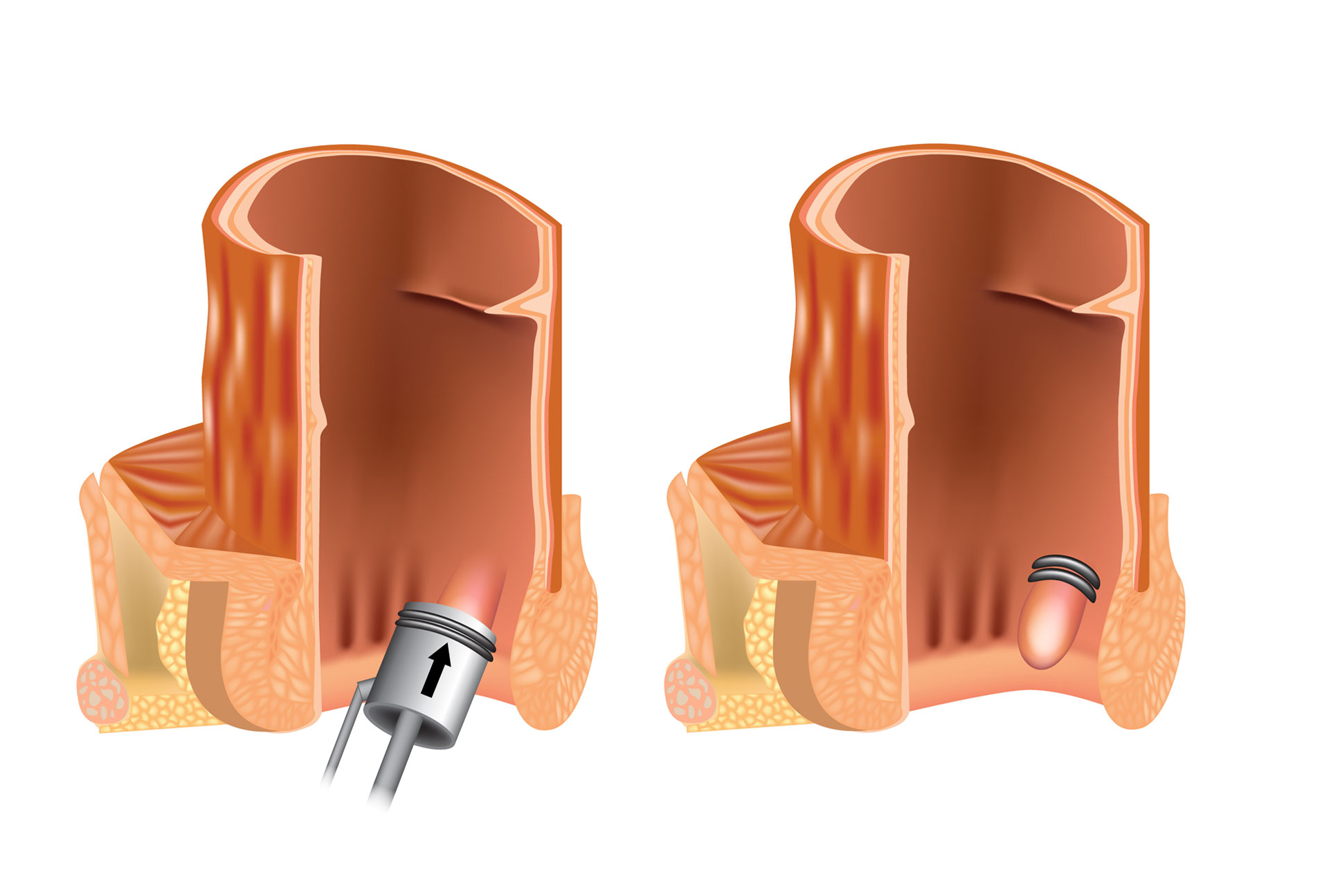 Rubber Band ligation of hemorrhoid is an office procedure to treat internal hemorrhoids without any pain in a minimal invasive way.