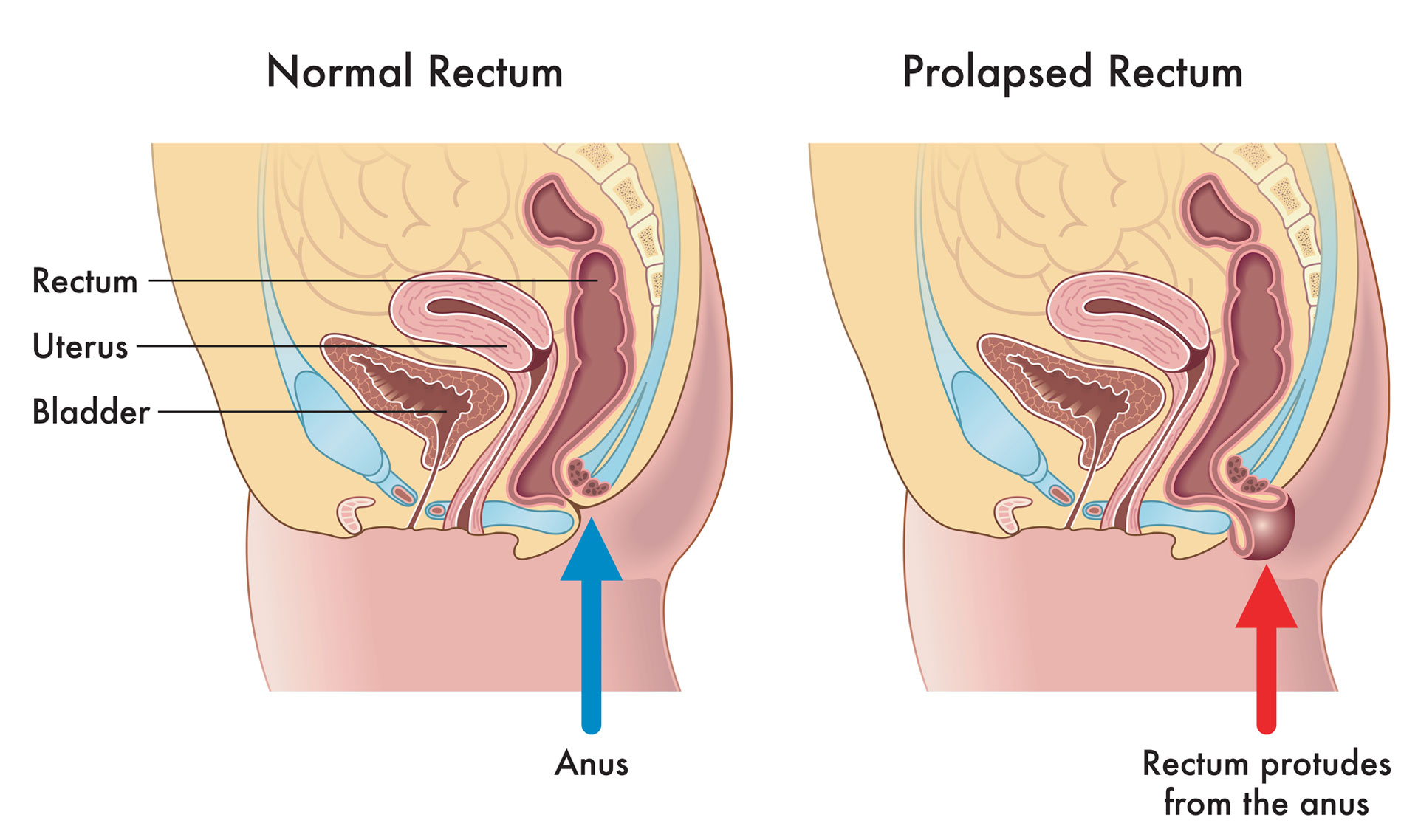 Rectal Prolapse Expanded Version