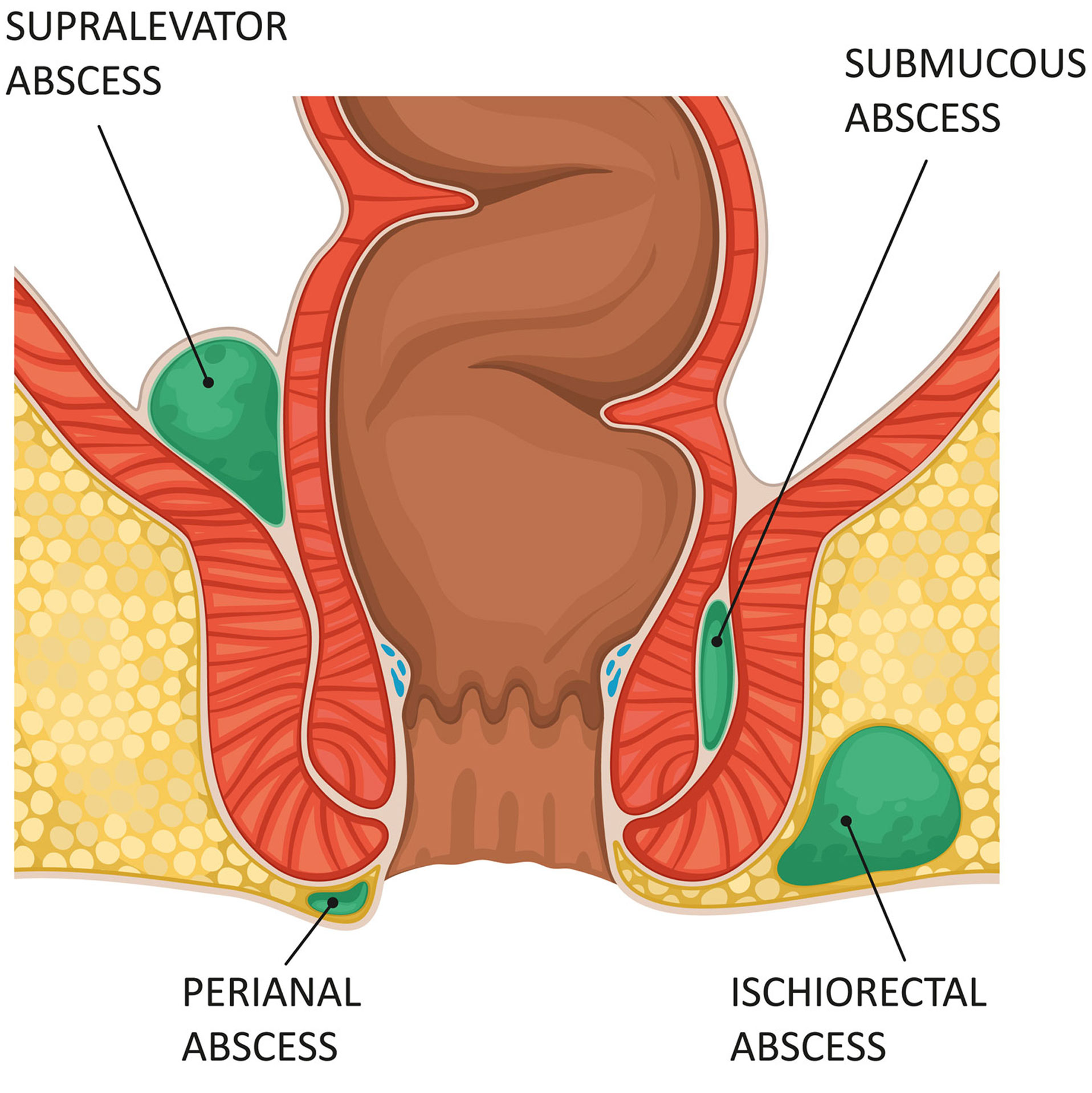 perirectal abscess