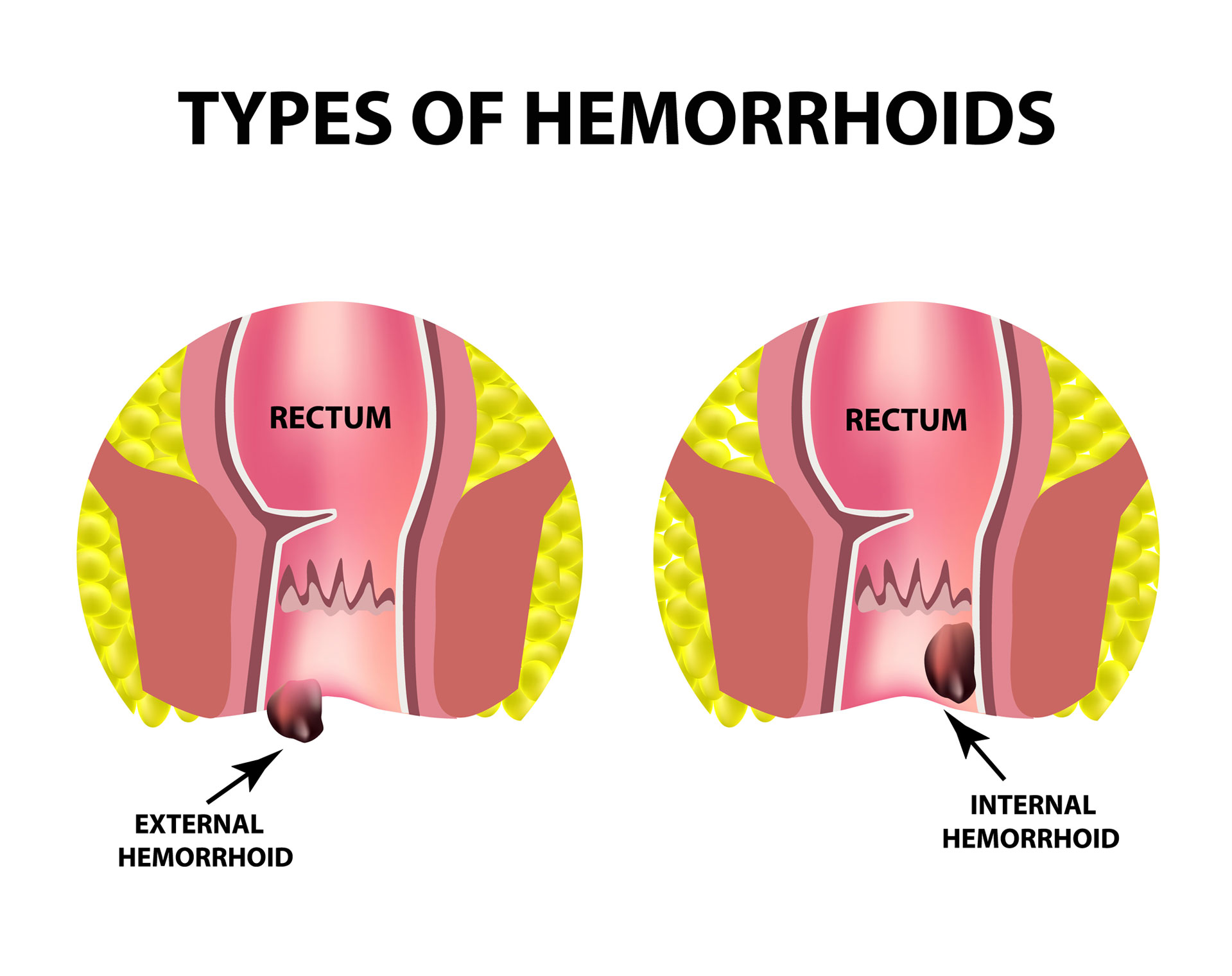 internal hemorrhoid bleeding