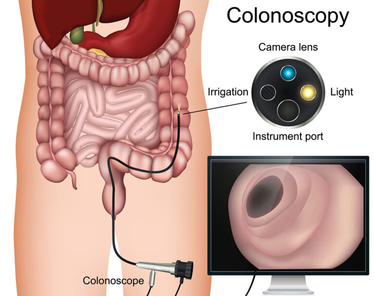 Colonoscopy