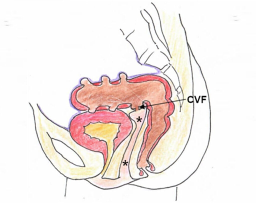 Colovaginal fistula