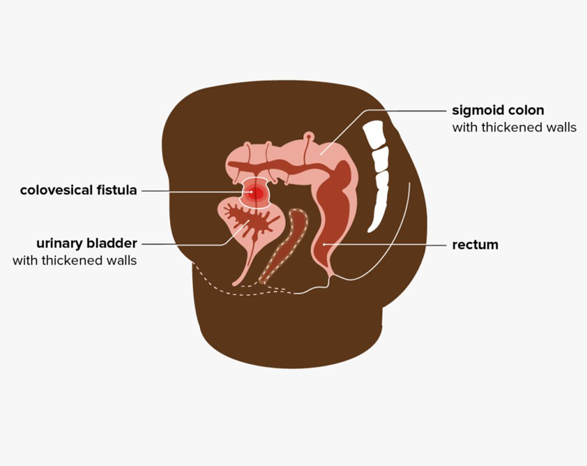 colovesical fistula