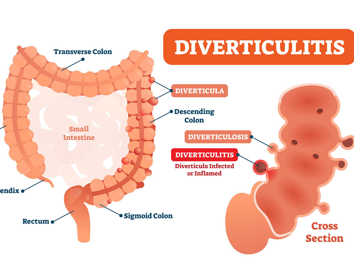 Diverticulitis & Diverticuosis