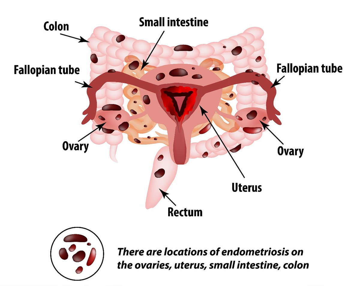 Endometriosis Involving Colon And Rectum (bowel)