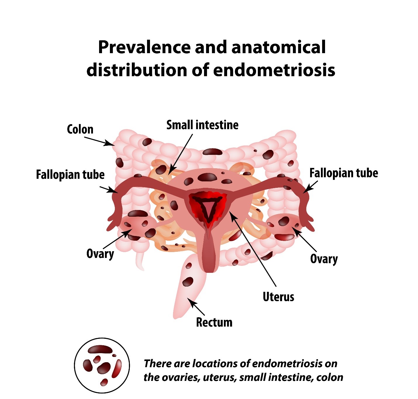 Bowel Endometriosis: Symptoms, diagnosis, and treatment