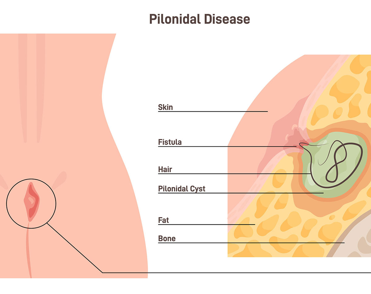 Pilonidal cyst and abscess