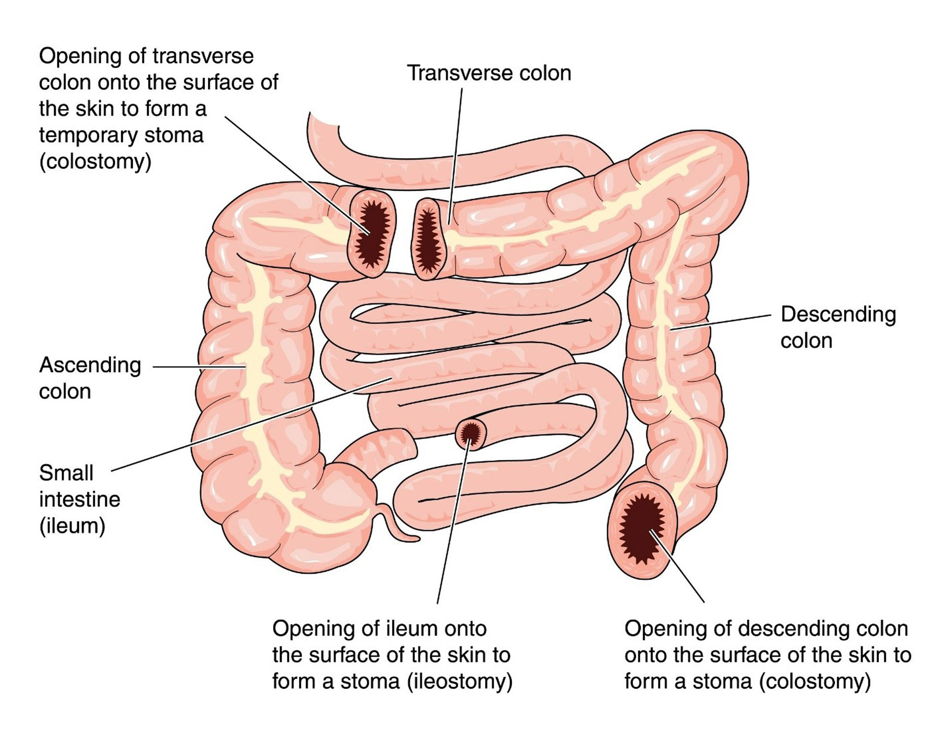 loop colostomy reversal