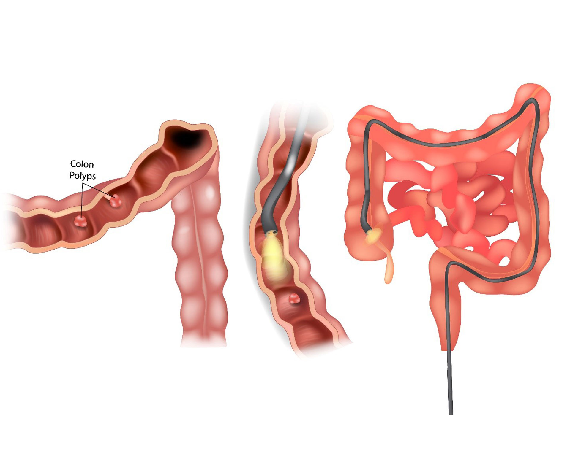 Colonoscopy