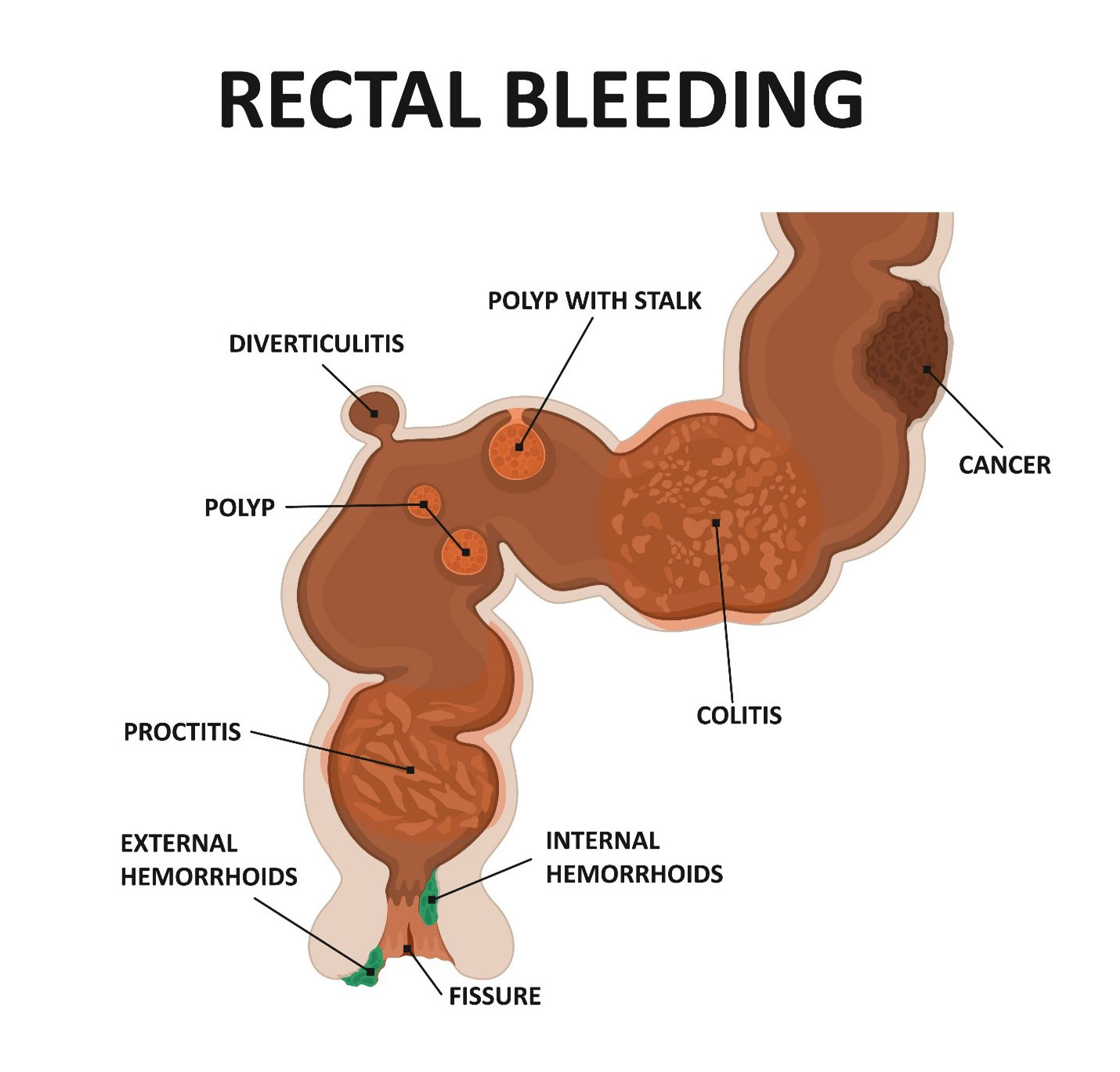 Rectal bleeding causes